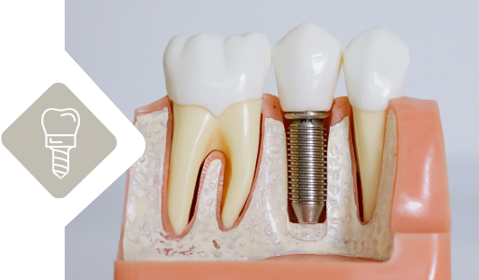 Ricostruzione dentale  Studio Dentistico Dr. med. dent. Daniel Herth